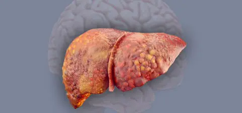 Diseased liver showing cirrhosis