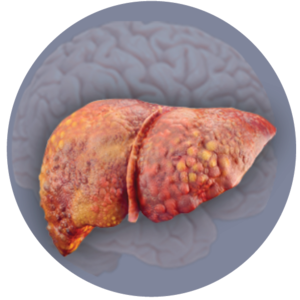 Overt Hepatic Encephalopathy (HE)